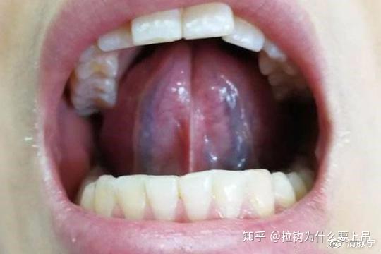 舌下颜色与疾病图片图片