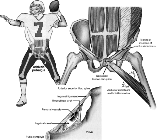 運動員腹股溝疼痛athleticpubalgia原因診斷治療