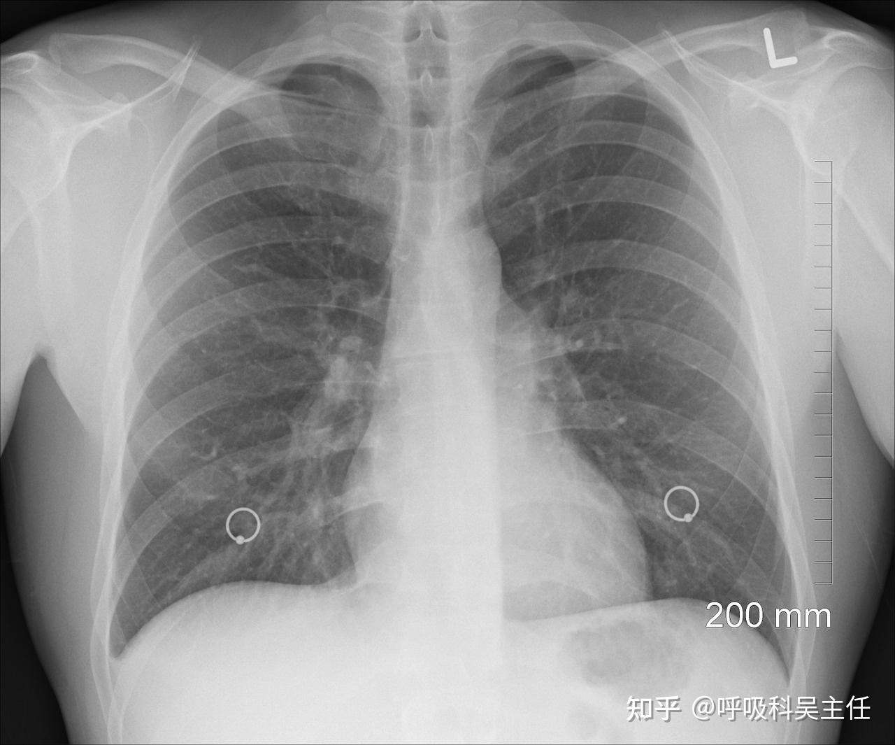 慢阻肺——慢性病杀手