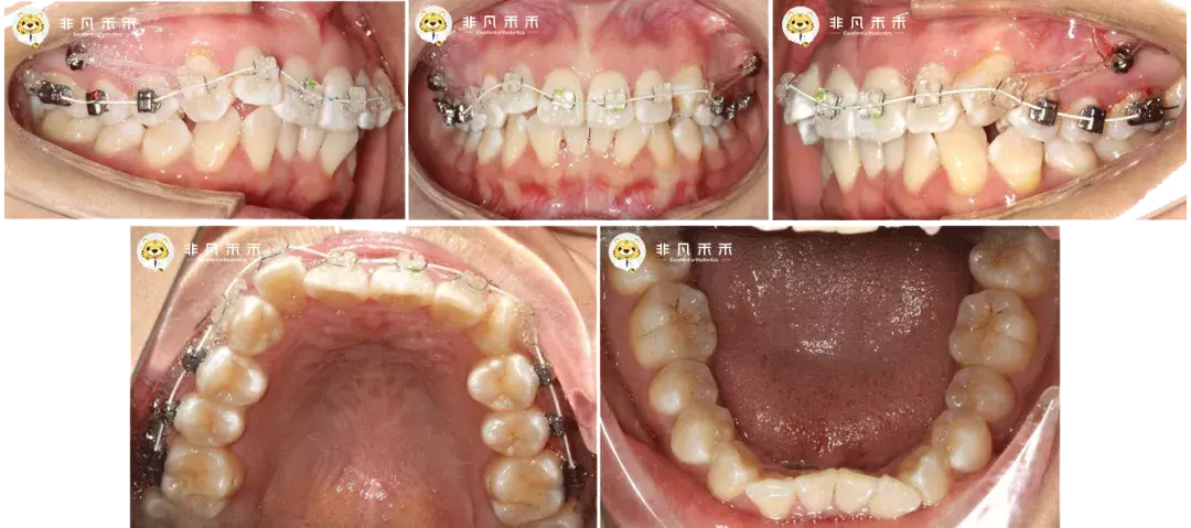 口内阶段照治疗过程23,上颌种植支抗帮助排齐内收上下前牙2,不拔牙