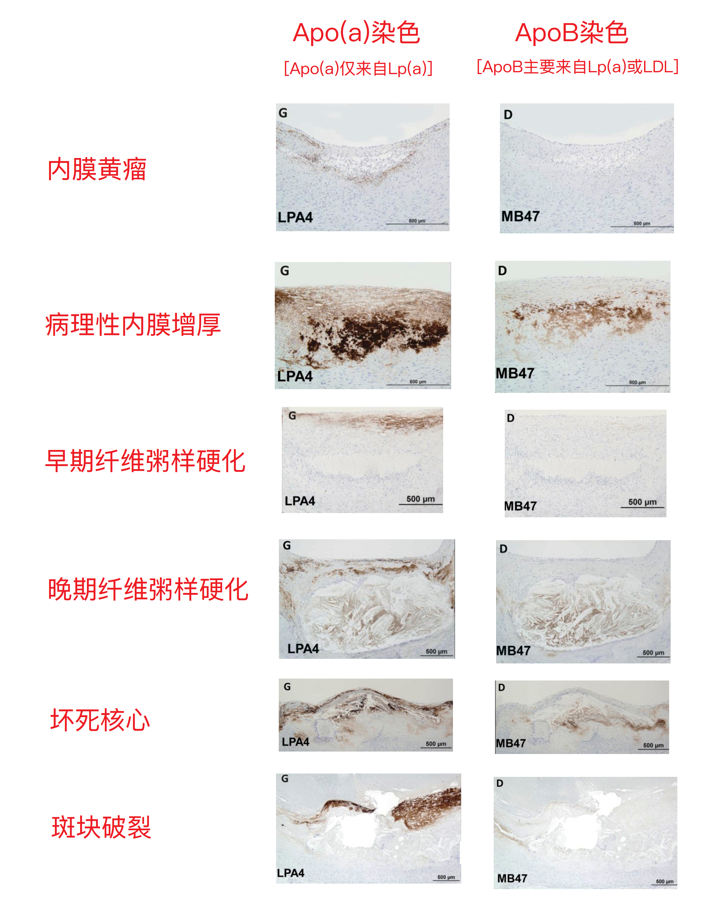 脂肪条纹与动粥斑块不相关