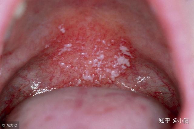吃槟榔舌癌症患者图片图片