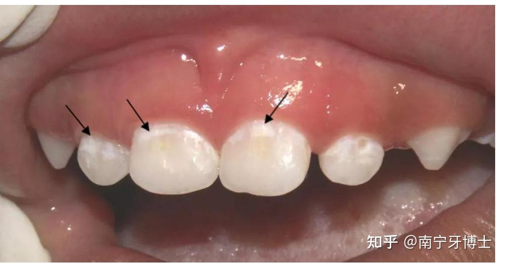 宝宝牙齿出现白斑!家长们赶紧了解一下乳牙脱矿!