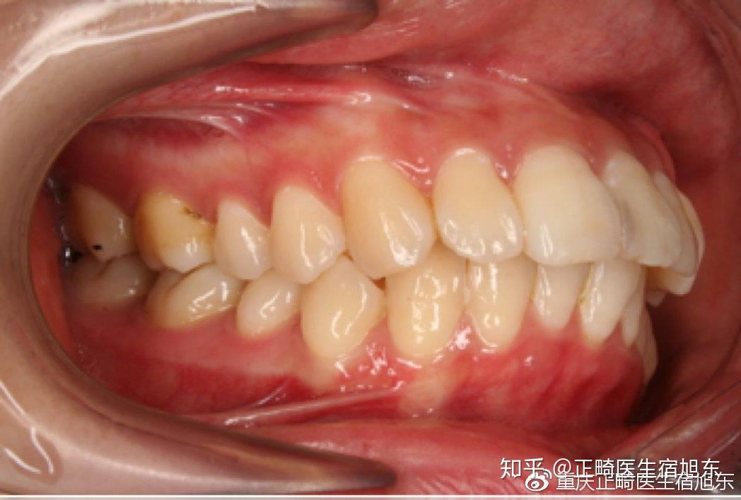 牙齒矯正那些事1什麼是正畸