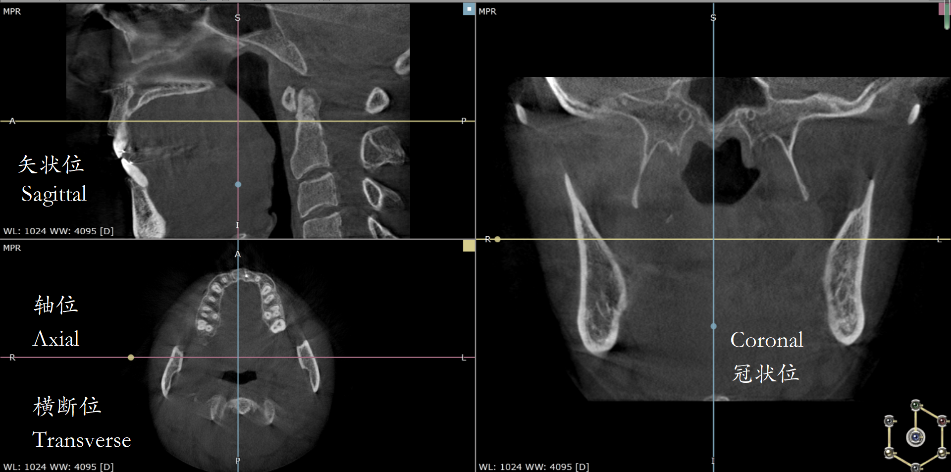 矢状位冠状位示意图图片