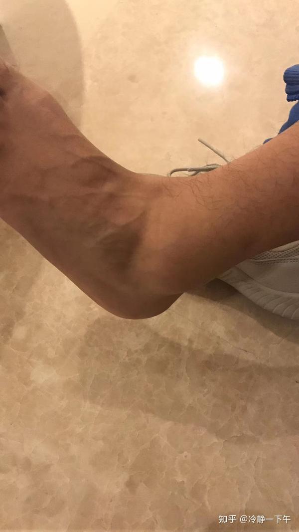 脚踝扭伤者的恢复之路1