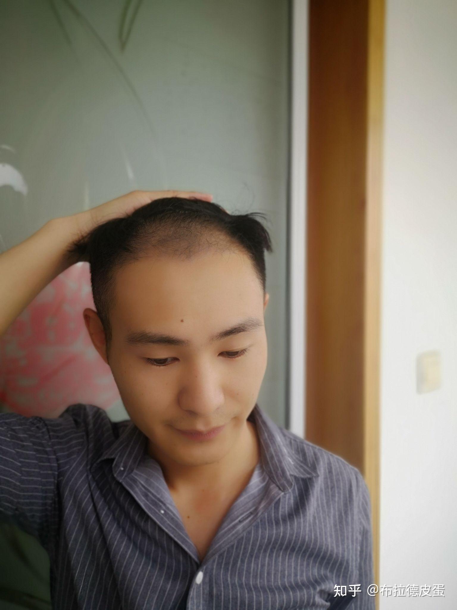 植发喝酒吸烟(植发喝酒会影响存活吗)