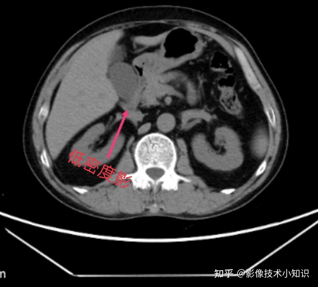 胰腺影像解剖 - 知乎