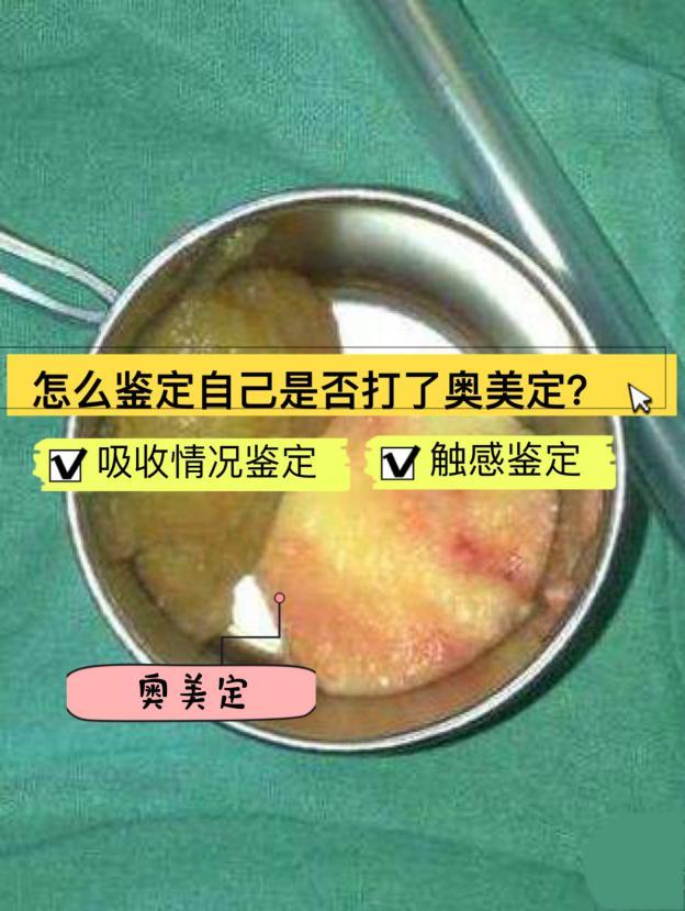来看看怎么鉴定自己是否打了奥美定?