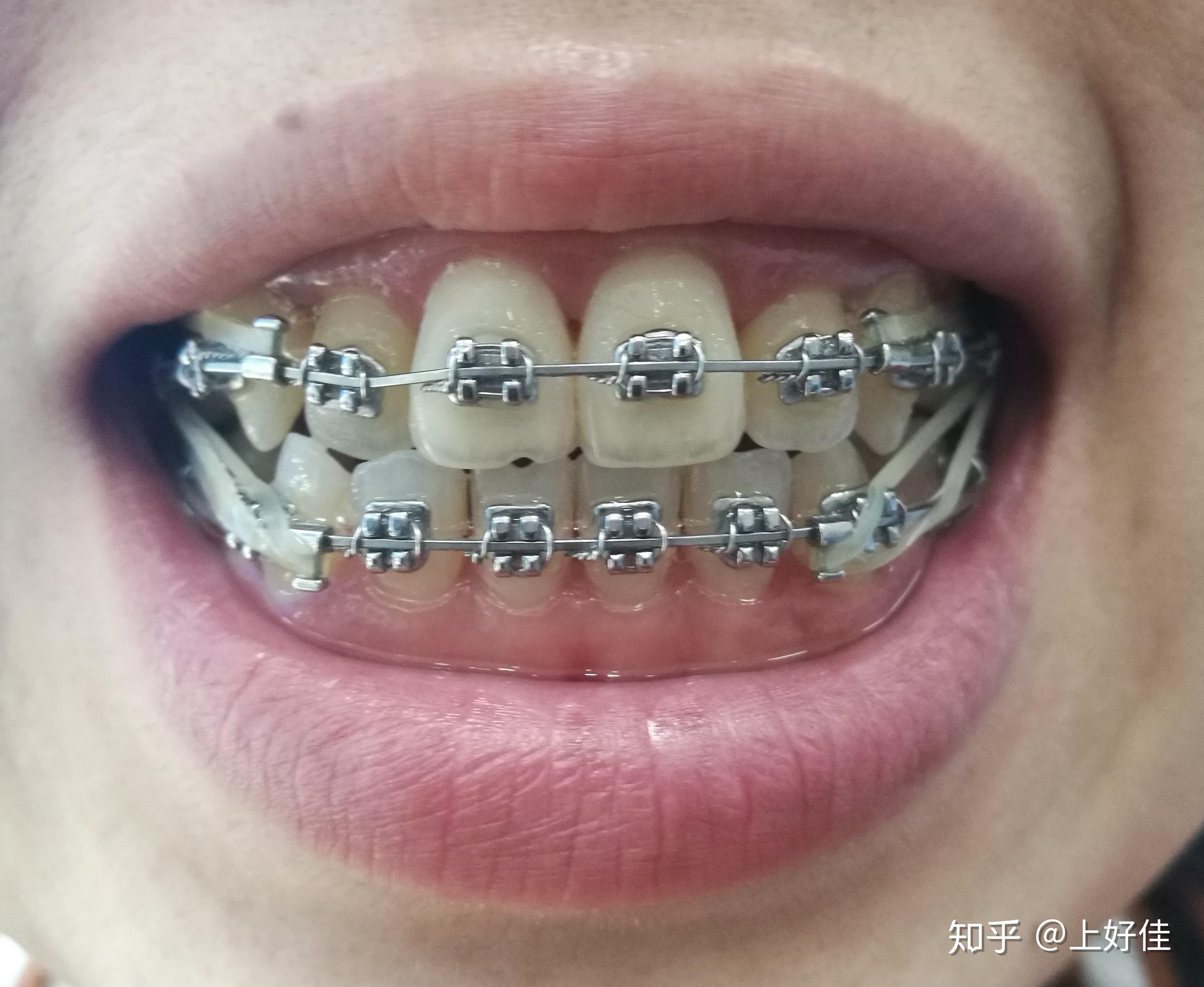 全同步带状弓整牙日记每周一更