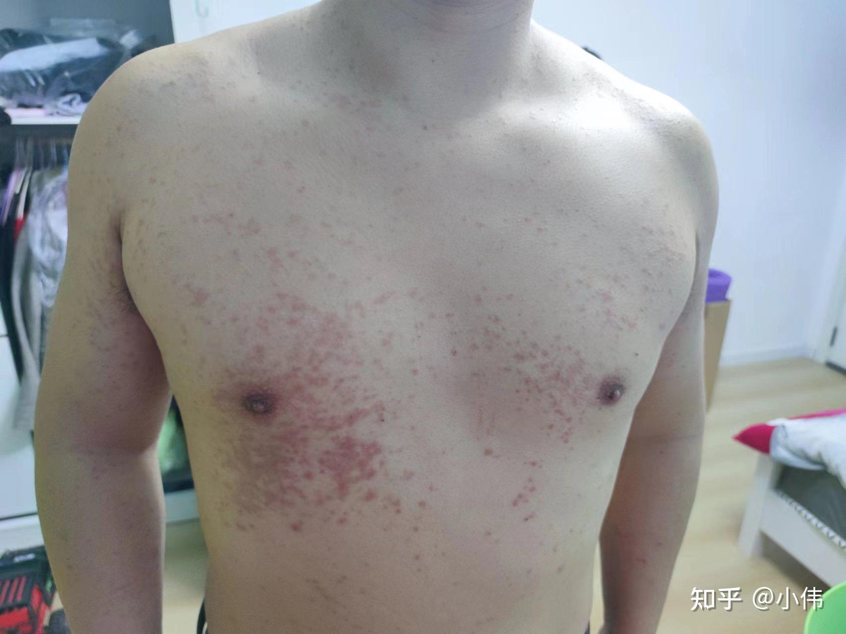 皮疹，荨麻疹，过敏性皮肤反应。照片摄影图片_ID:167697041-Veer图库