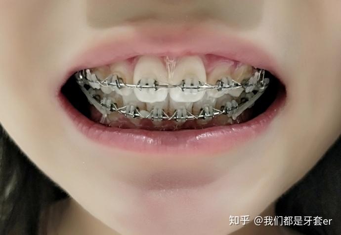 矫正 | 双颌前突,从小被叫大龅牙,不敢笑,历时8年说服家人才戴上牙套