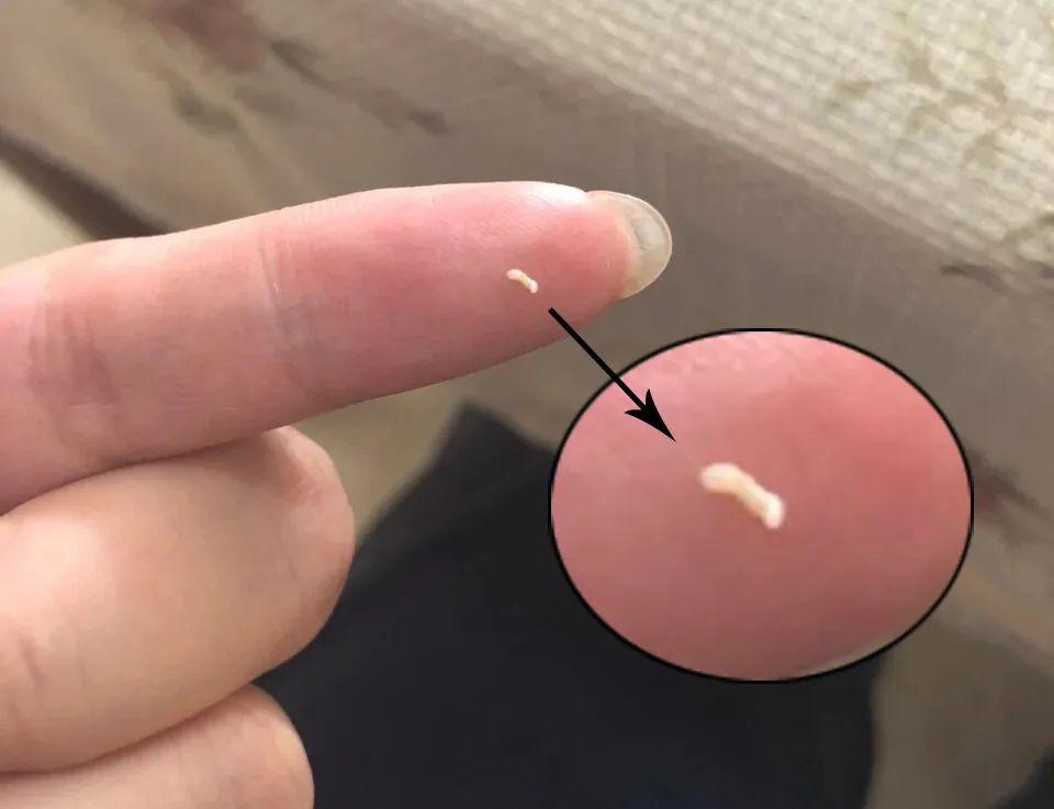 身上鼻子上挤出黄粒粒说明螨虫已过亿30秒揪出螨虫还是国货牛