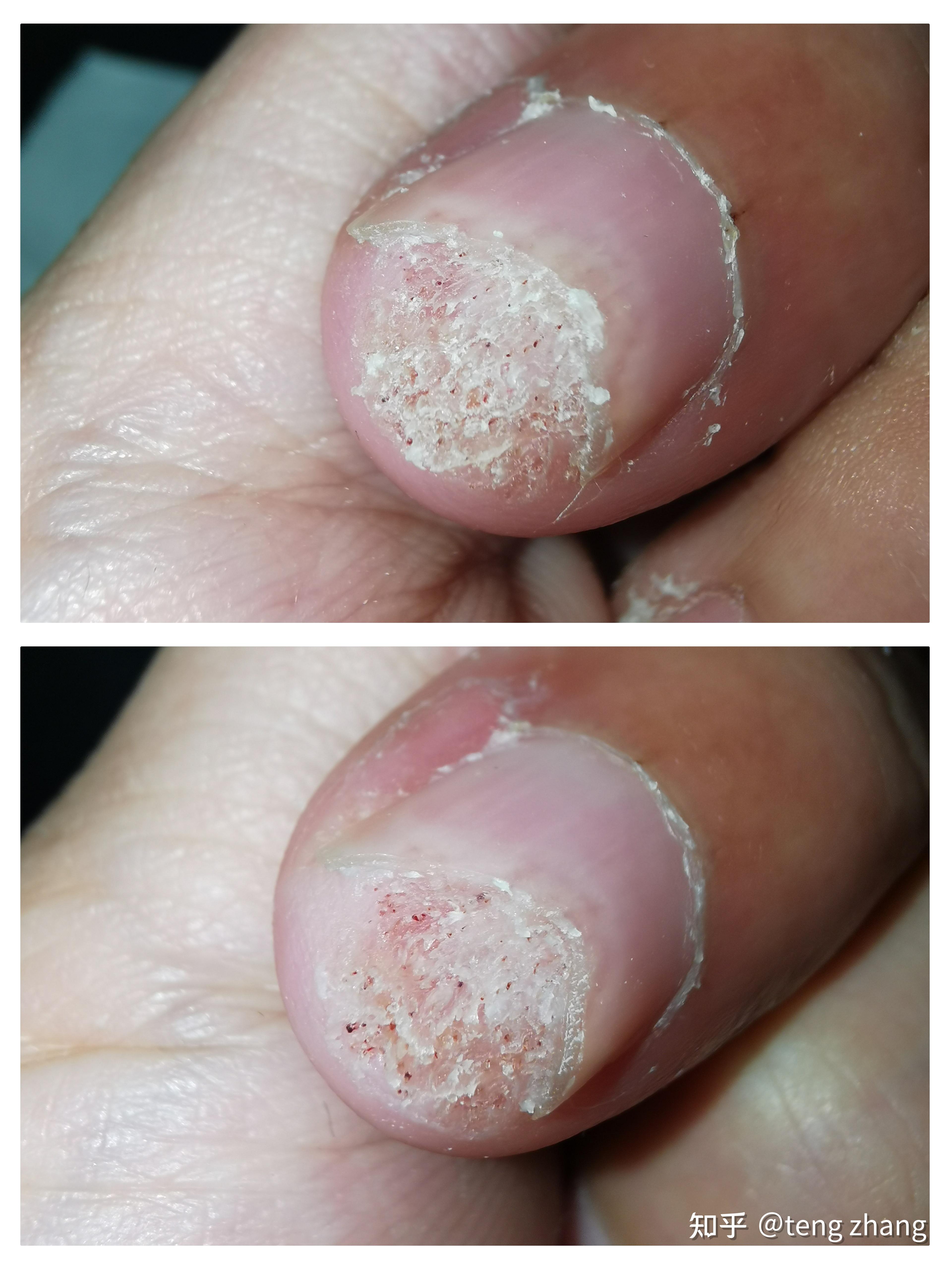 到22号外围都清理掉了,只剩下中间和靠近指甲最深处的位置,最后一图