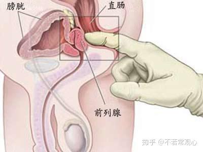 有哪些靠谱的方法可以治疗前列腺炎 快收藏 知乎