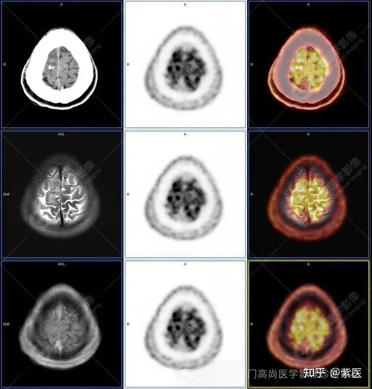 PET/CT-MR 多模态融合技术在临床中的应用病例分享（一） - 知乎