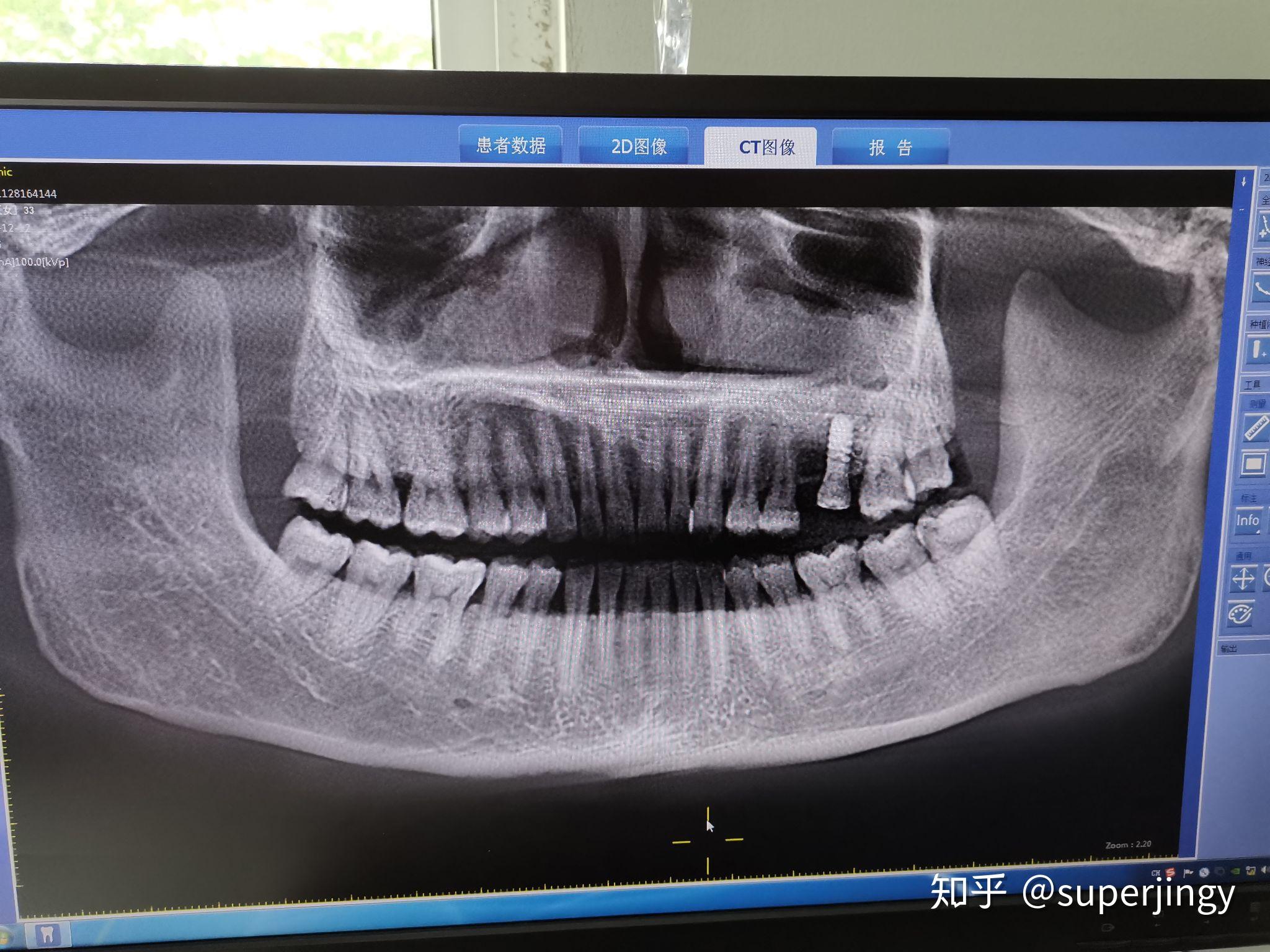 种植牙x片图片