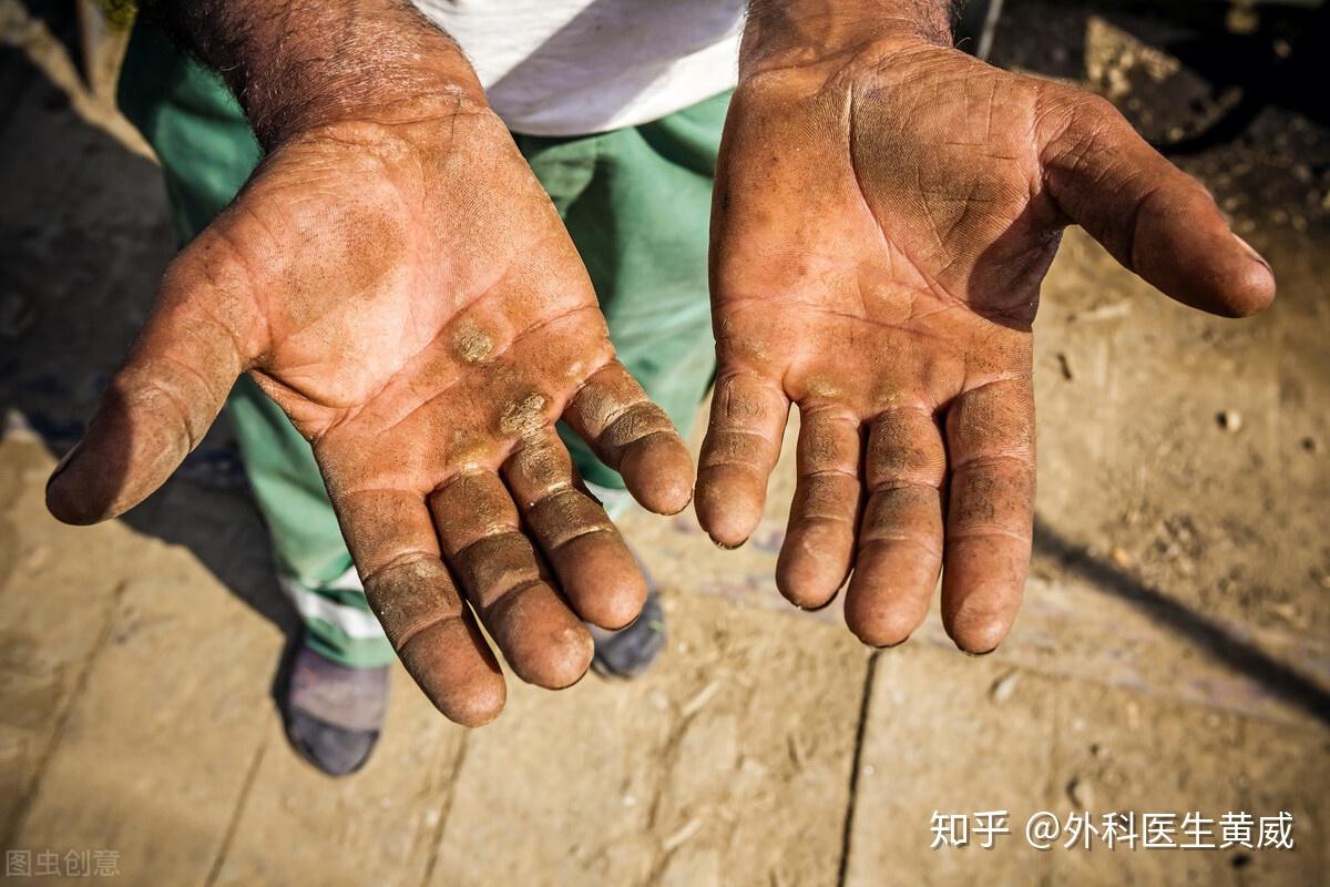 操作不慎,四指被冲床压断