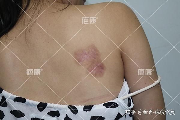 真實病例北京宋女士前胸後背6年疤痕疙瘩