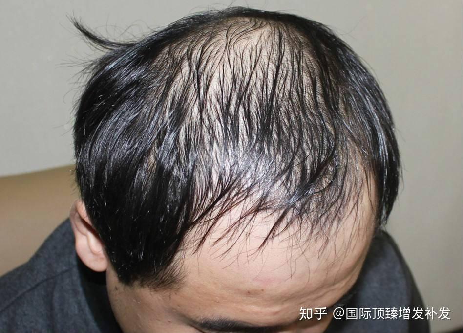 国际顶臻美学补发效果好吗脂溢性脱发秃顶如何自救