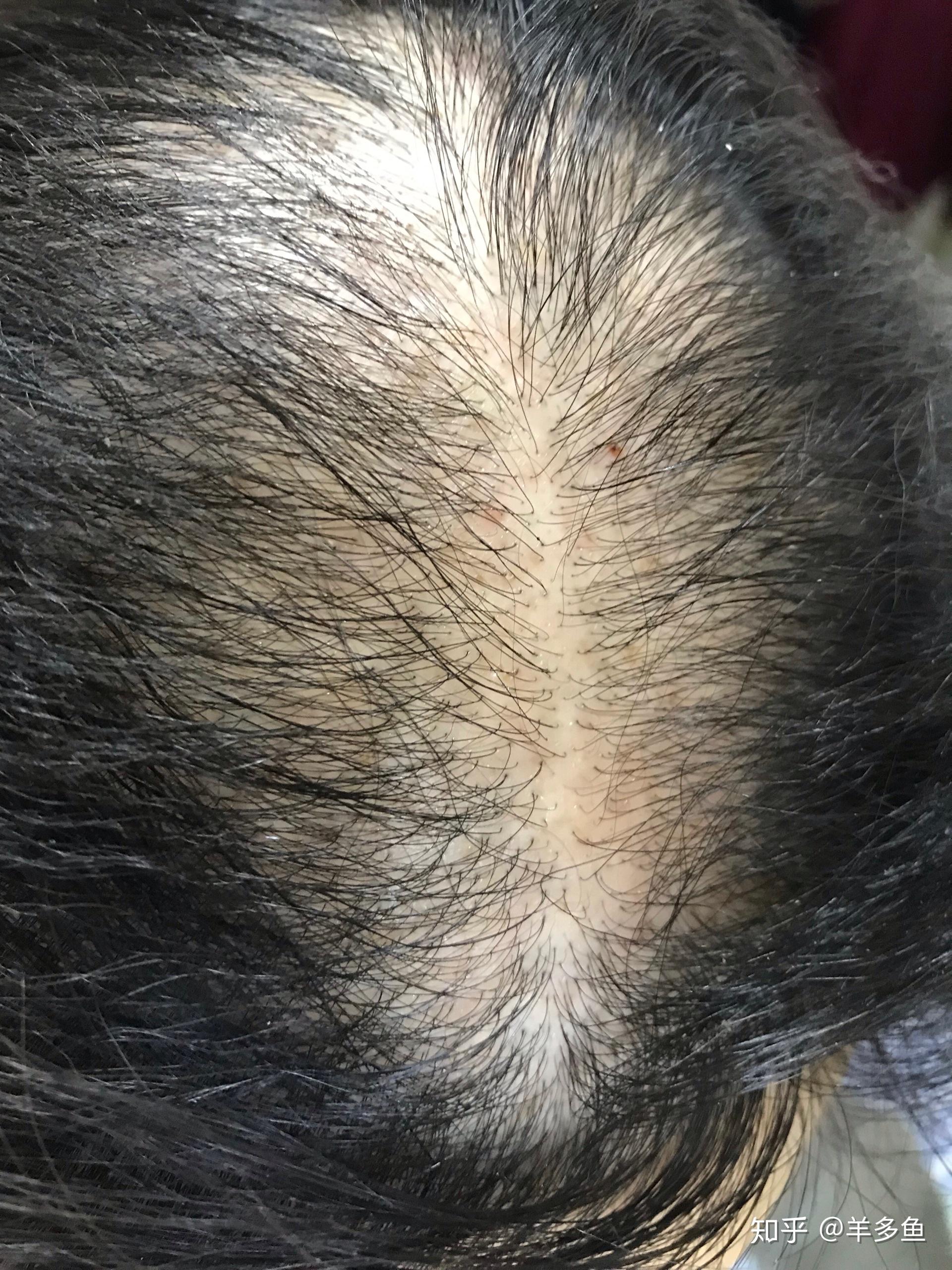 女性脂溢性脱发好崩溃