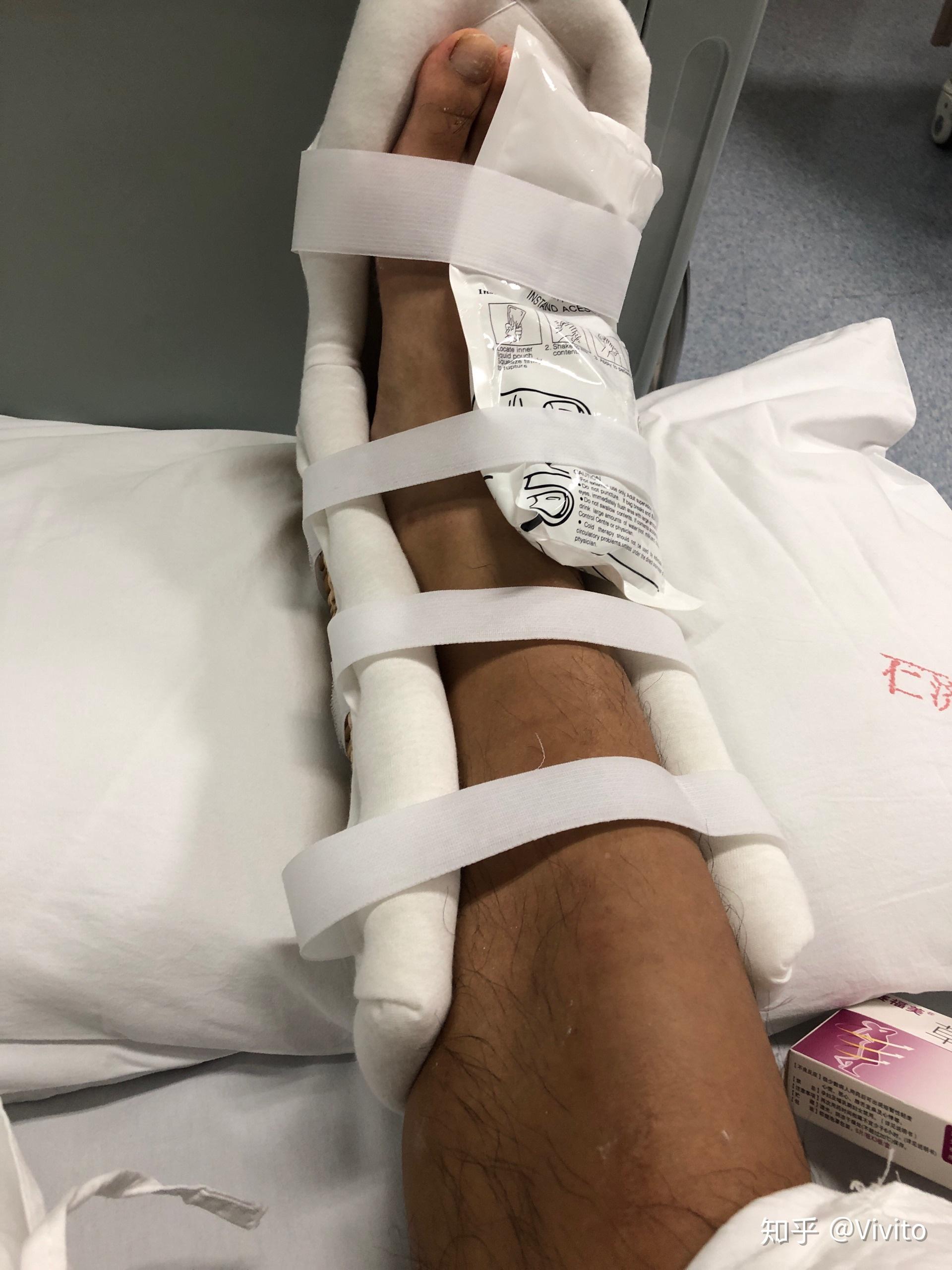 腓骨骨折康复记录