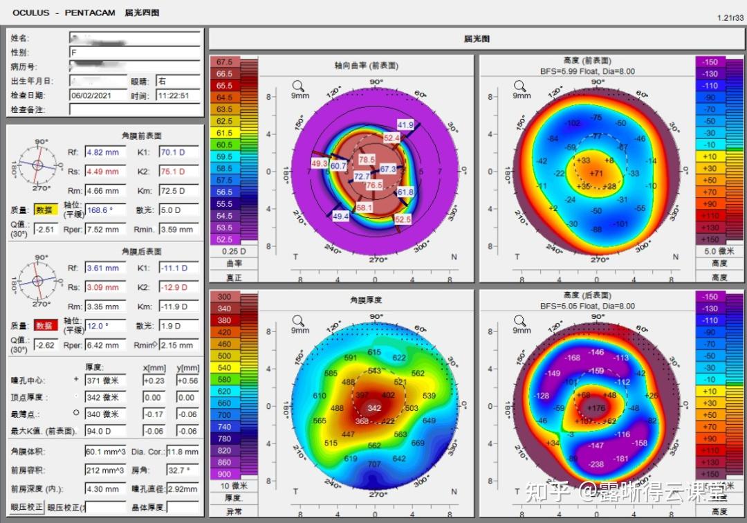 圆锥角膜的RGP验配及RGP临床效果分析（文字版） - 知乎