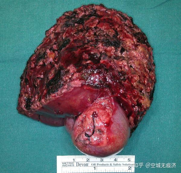 良性一般称为瘤,恶性肿瘤来自上皮组织称为癌.