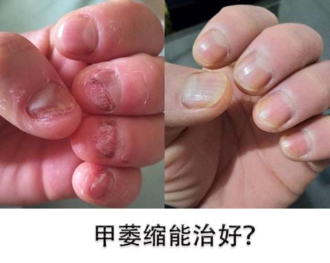 【灰指甲】感染十几年灰指甲的根除案例分享灰指甲严重到甲萎缩,根除