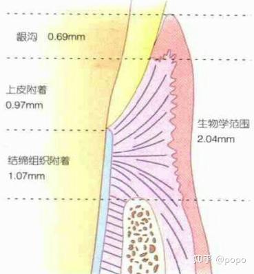 临床上龈上牙龈与修复体边缘的关系 - 知乎