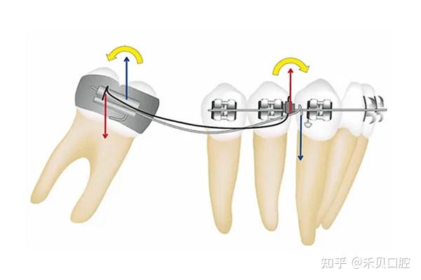 牙齿深覆合如何打开咬合? - 知乎