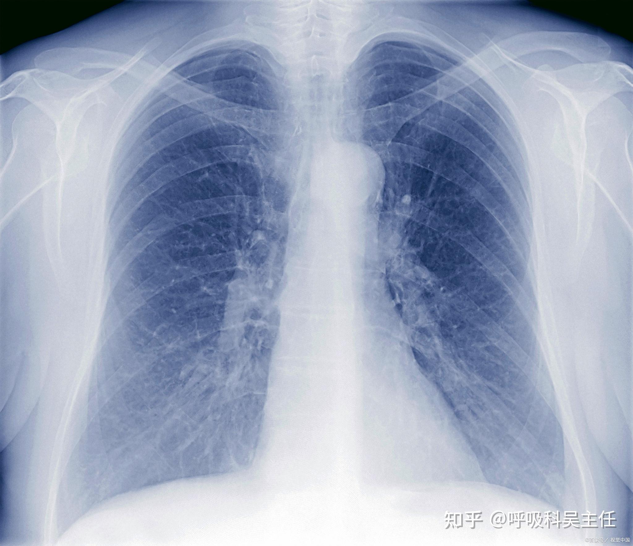 肺部感染片子图片图片