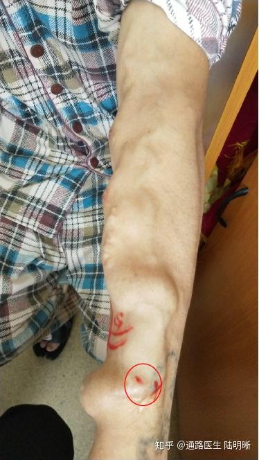 血管折角型狭窄的超声表现