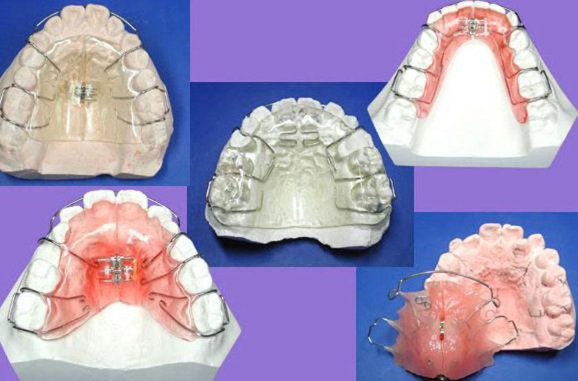 正畸第二讲活动矫治器矫治注意事项
