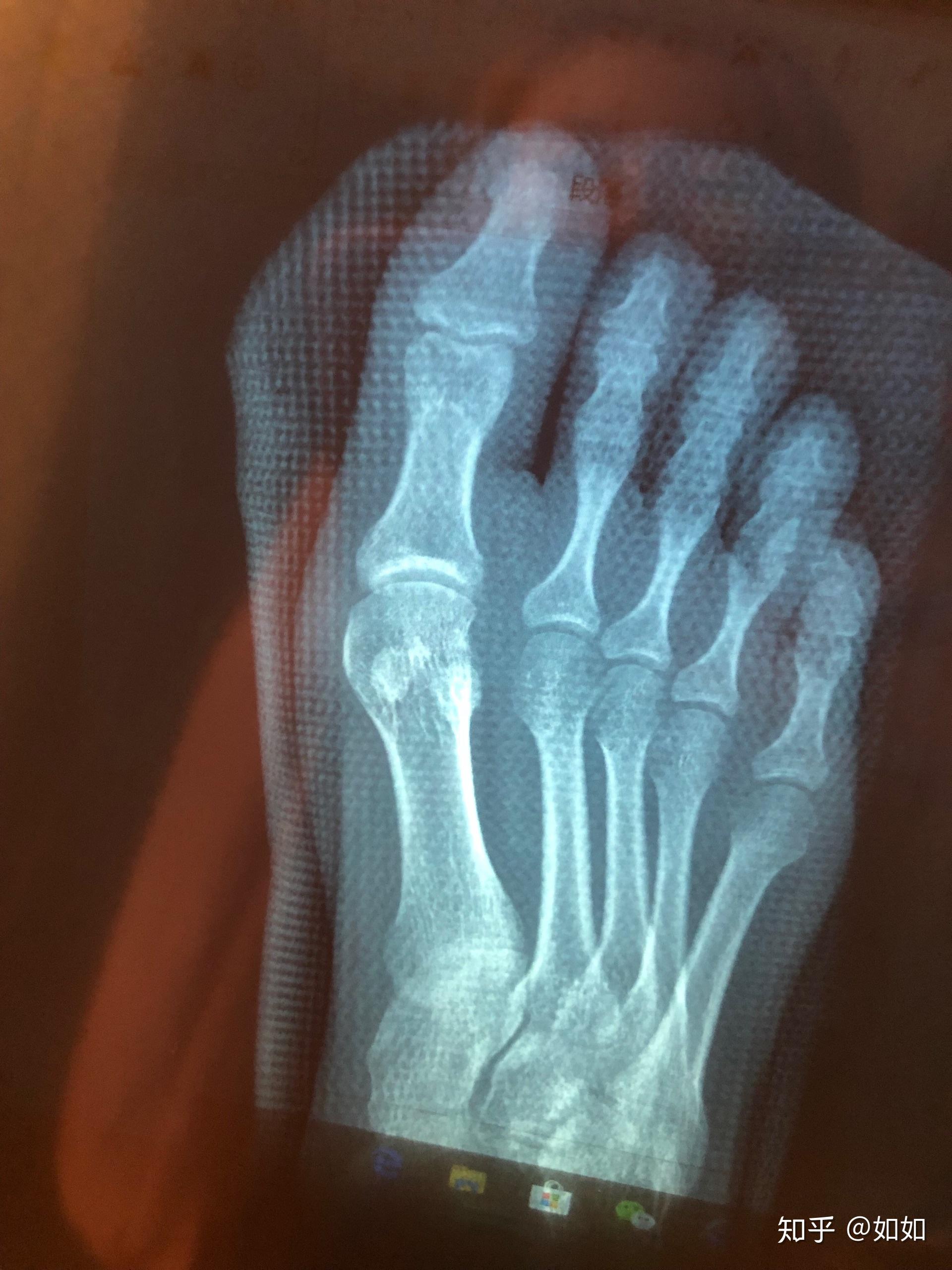 一例右足第2、3、4跖骨骨折的治疗方法 - 病例中心(诊疗助手) - 爱爱医医学网