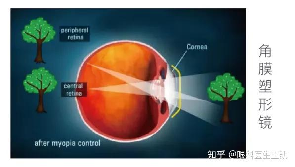 夜戴角膜塑形鏡vs日戴周邊離焦軟鏡哪種更適合你的孩子