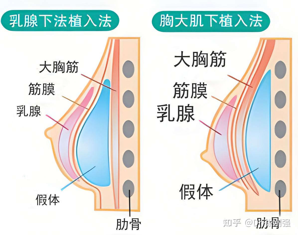 假体隆胸3d演示过程图片