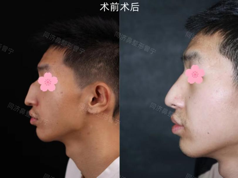 鼻梁骨中间骨头凸起,磨平驼峰后鼻梁会变塌吗? - 知乎