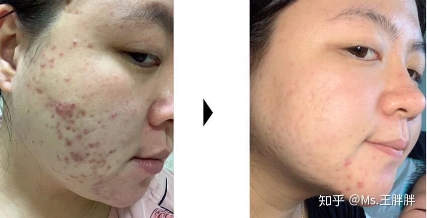 痘痘好祛,痘印难消,今天我就来说一说干货,怎么祛痘印93 - 知乎