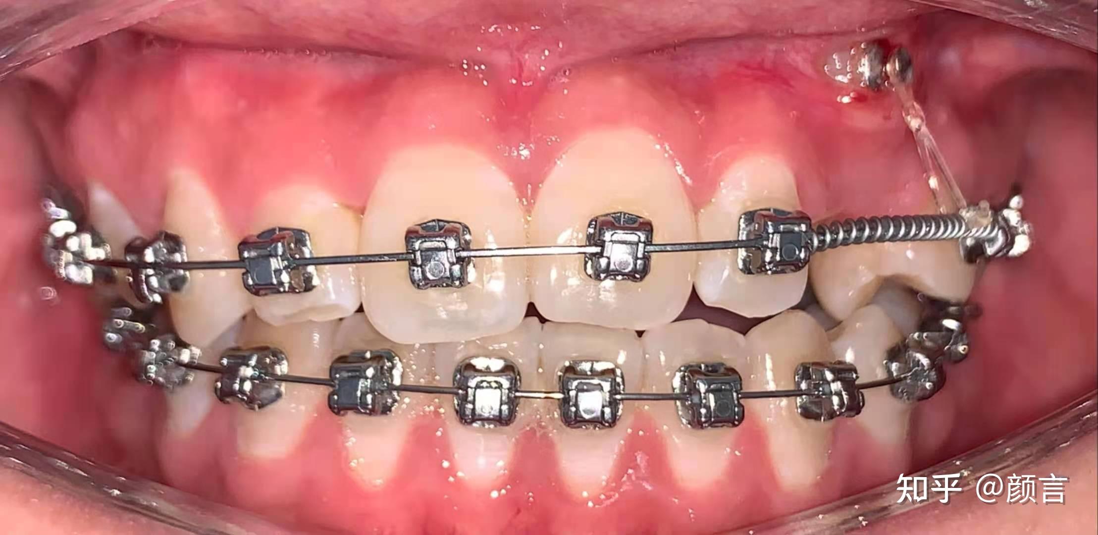 什么是牙齿牵引 - 知乎
