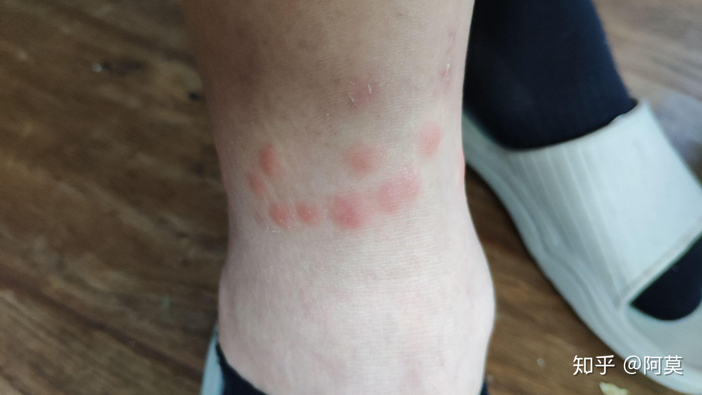 亲测被跳蚤咬了止痒消肿的绝对有效的办法!