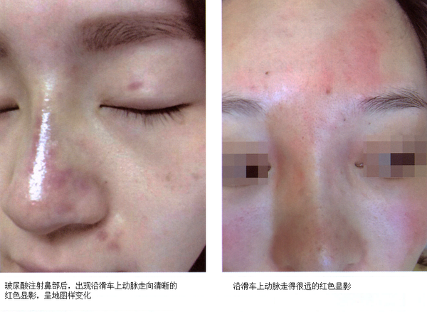 栓塞;如果症状明显连成一片,或者和周围部位白色明暗交替,形成花斑样