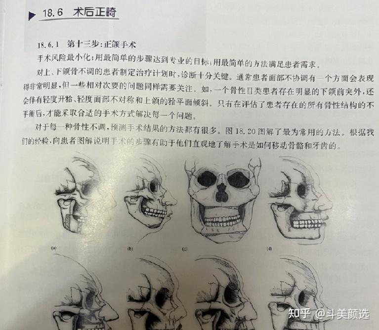 正颌手术要什么条件才可以做直术,不用先正畸牙齿? - 知乎