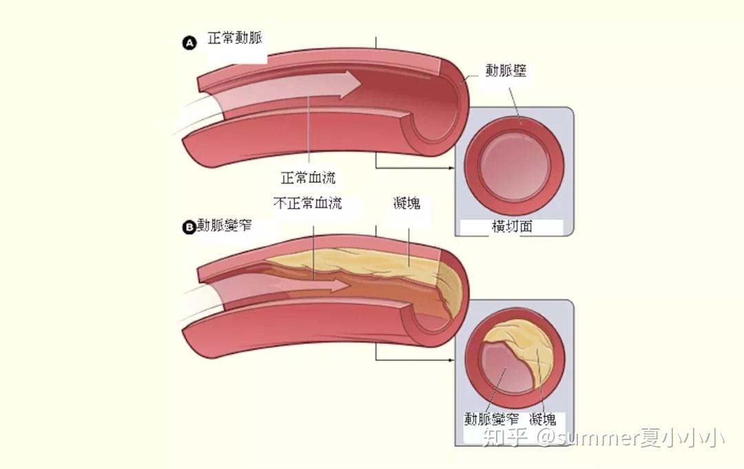 心肌脂肪浸润图片