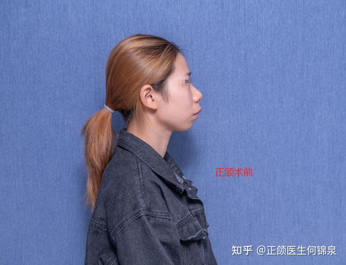 颌骨矫正的危害_颌骨纠正_颌骨矫正