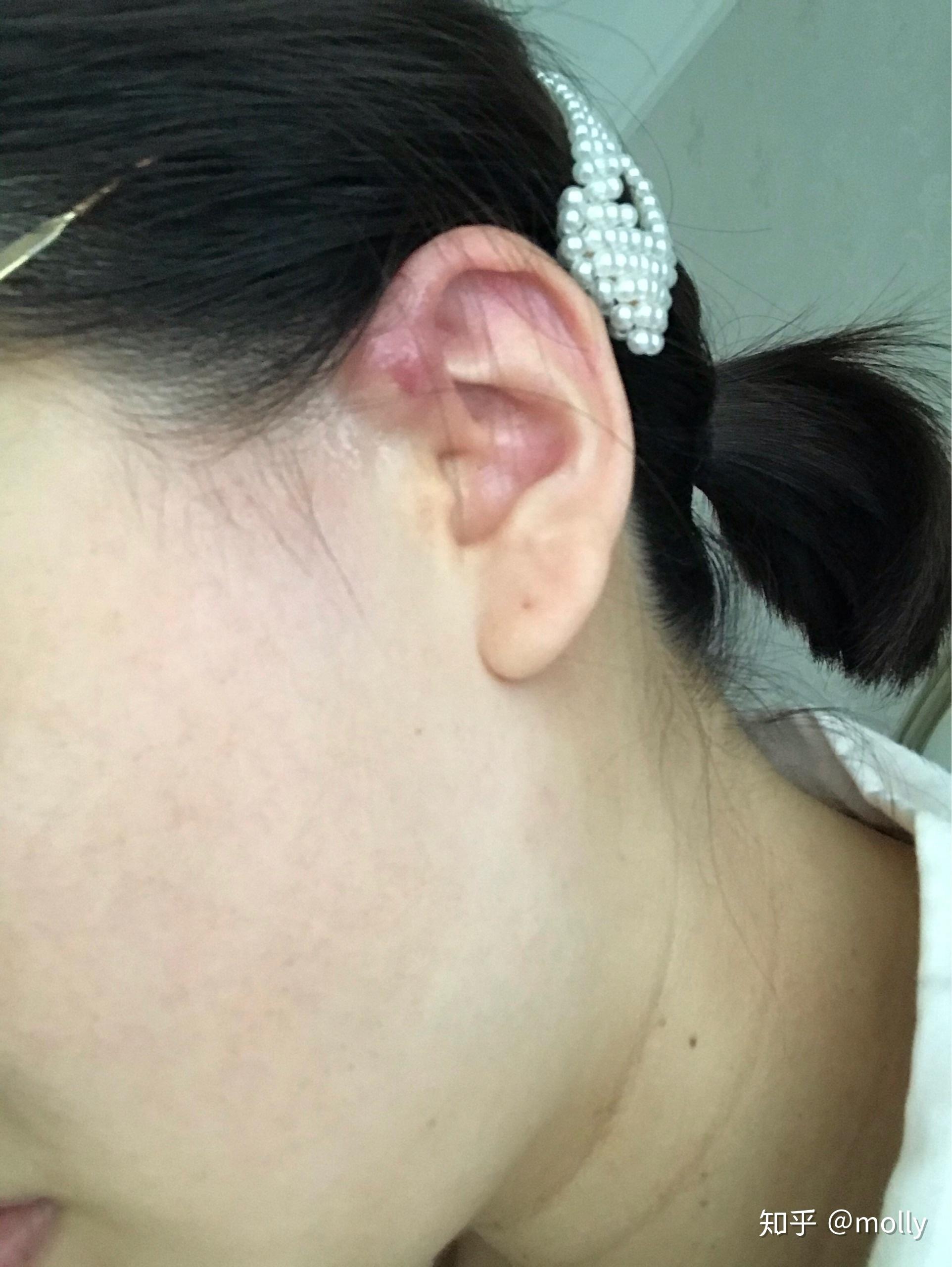 患有先天性耳前瘘管是一种怎样的体验？ - 知乎