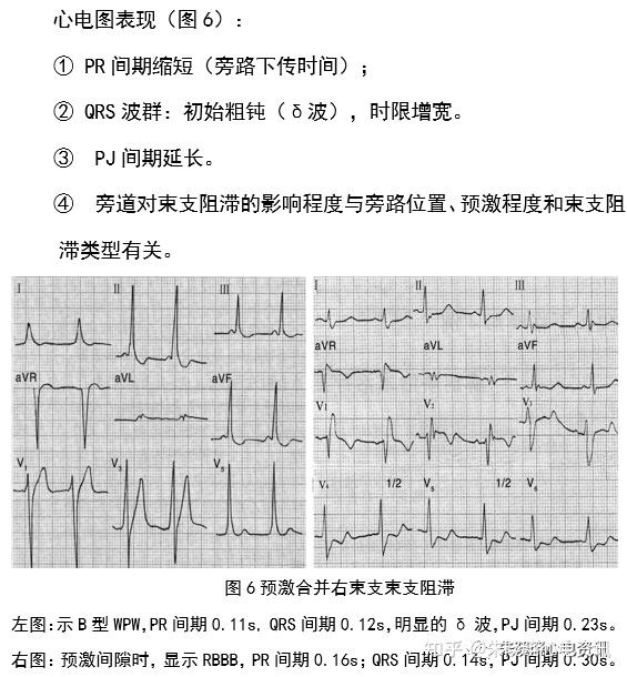 预激综合征心电图少见表现与诊断思路