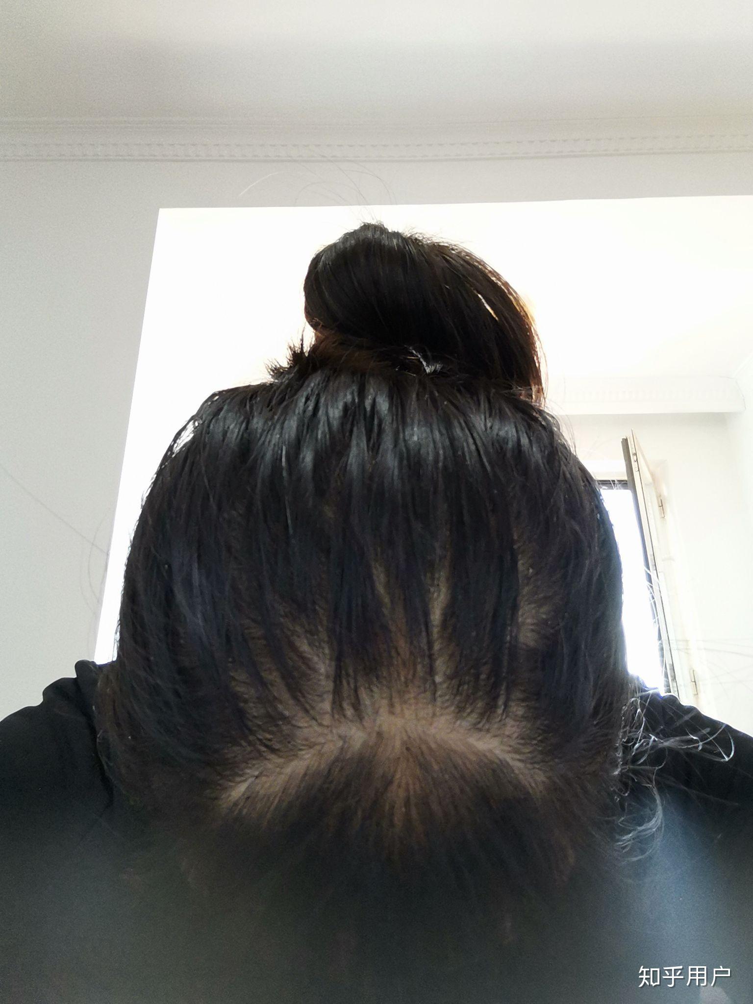 女生头顶头发少是什么体验