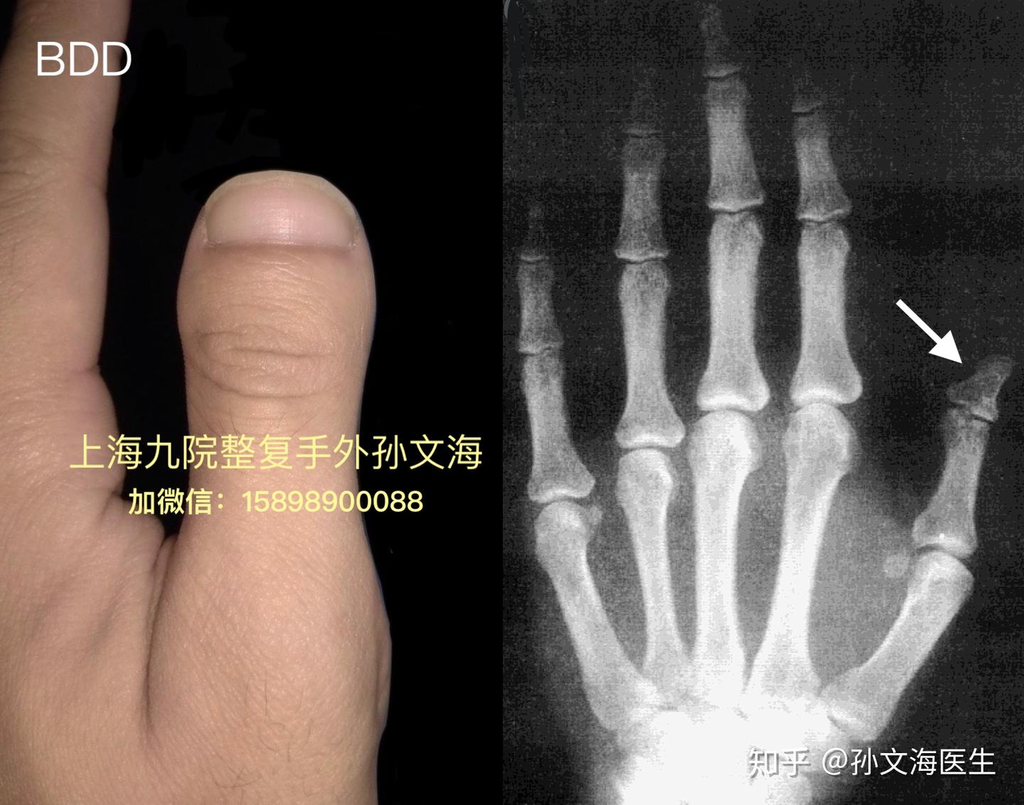 短指症d型