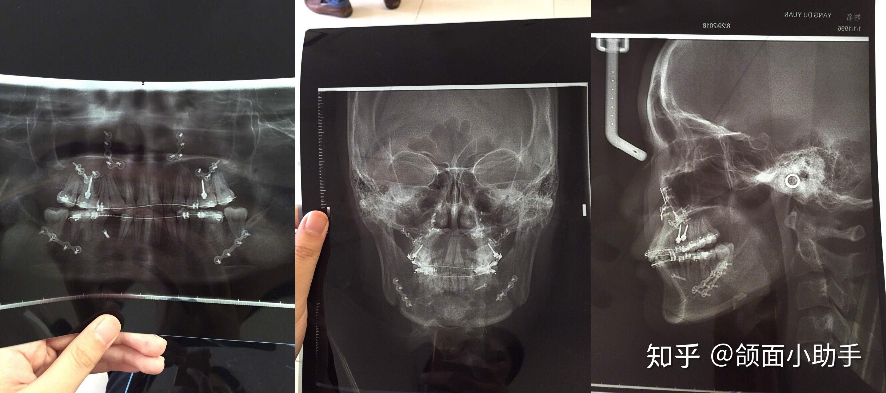 上海正颌手术日记轻微骨性反颌偏颌